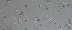 Imagem de Azoospermia obstructiva