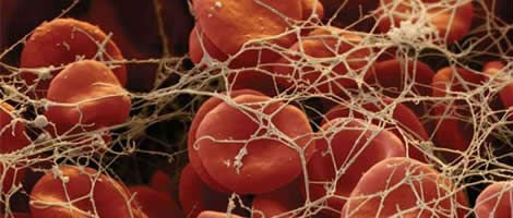 Coágulos de Sangue Menstrual