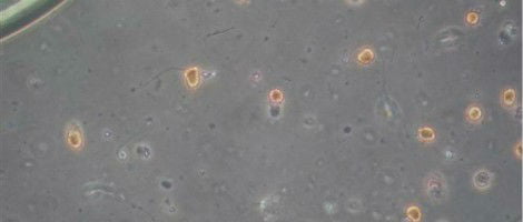 Análise da Quantidade de Leucócitos no Esperma