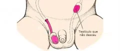 Criptorquia